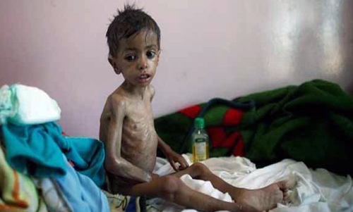 سازمان ملل: سال 2018، 400 نفر در یمن قربانی «وبا» شدند