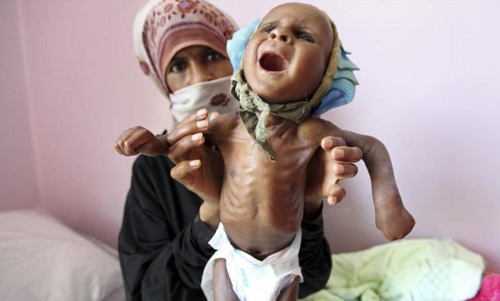 گسترش وبا در یمن در سایه تداوم حملات ائتلاف متجاوز سعودی