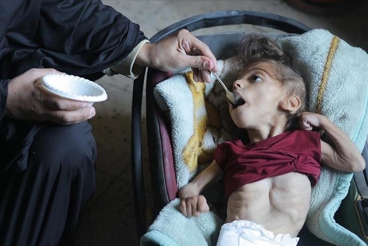 UN Warns of Severe Malnutrition in 100,000 Children in Gaza UN Warns of Severe Malnutrition in 100,000 Children in Gaza
