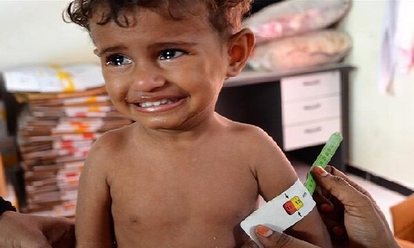 افزایش نگران‌کننده سوء تغذیه حاد در میان کودکان یمنی