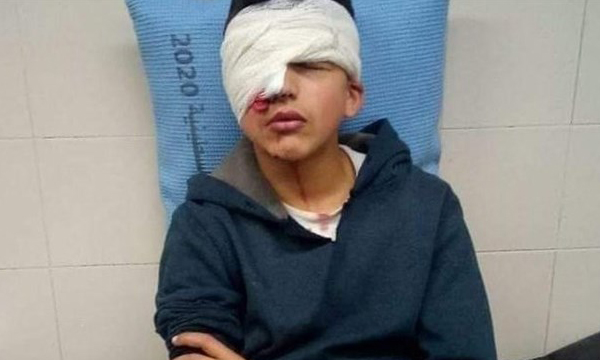 نابینا شدن کودک فلسطینی به ضرب گلوله نظامیان صهیونیست