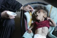 UN Warns of Severe Malnutrition in 100,000 Children in Gaza